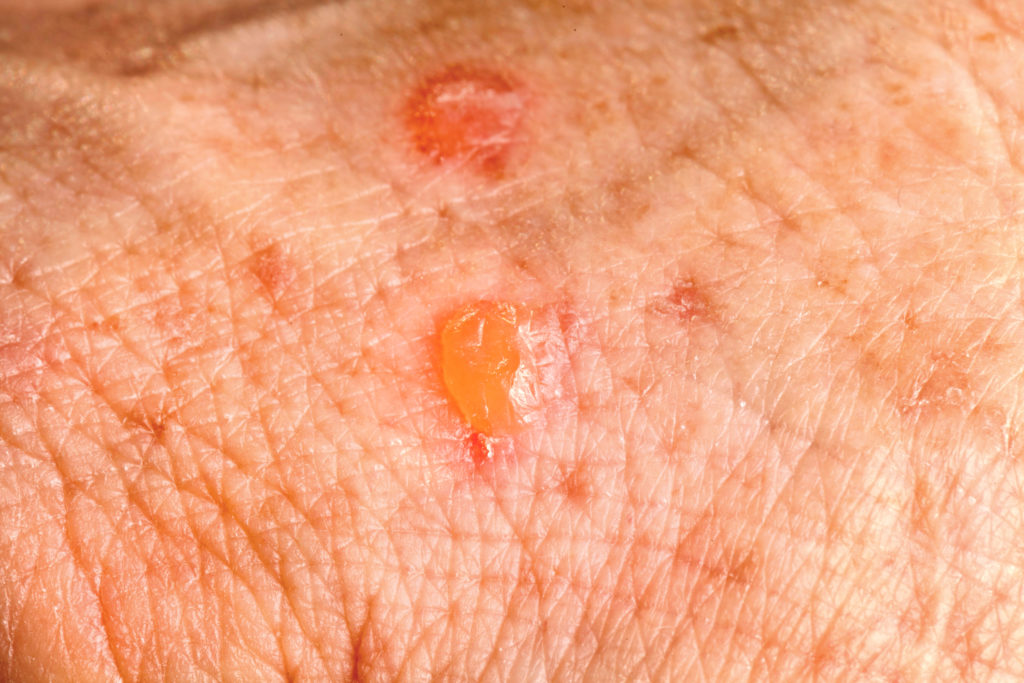 what is Actinic Keratosis skin cancer