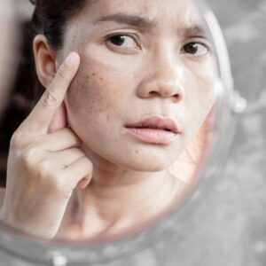 Woman looking at hyperpigmentation